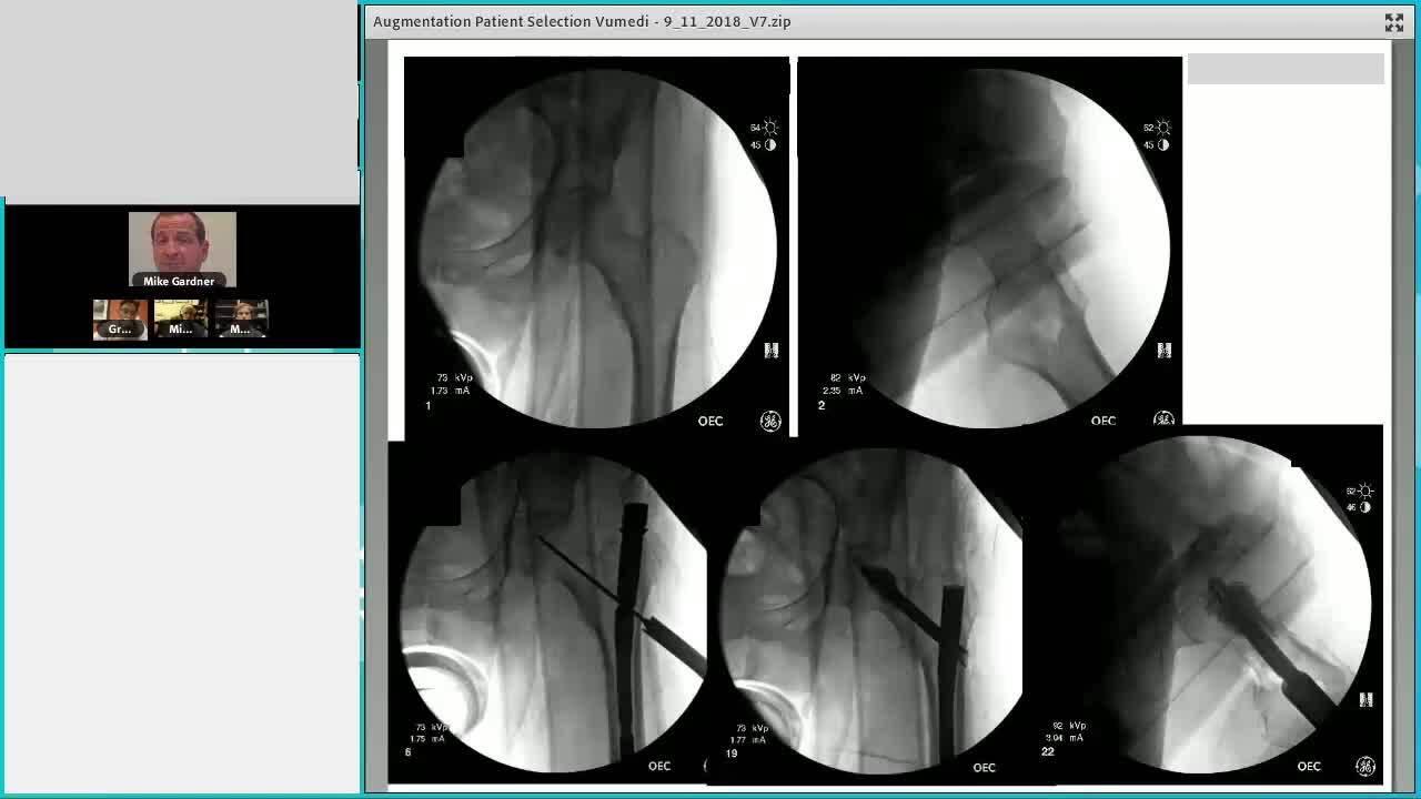 An image from the "Augmenting Geriatric Hip Fractures: Logical Indications Through Case Examples with Michael Gardner, MD" video on the JnJInstitute.com website.