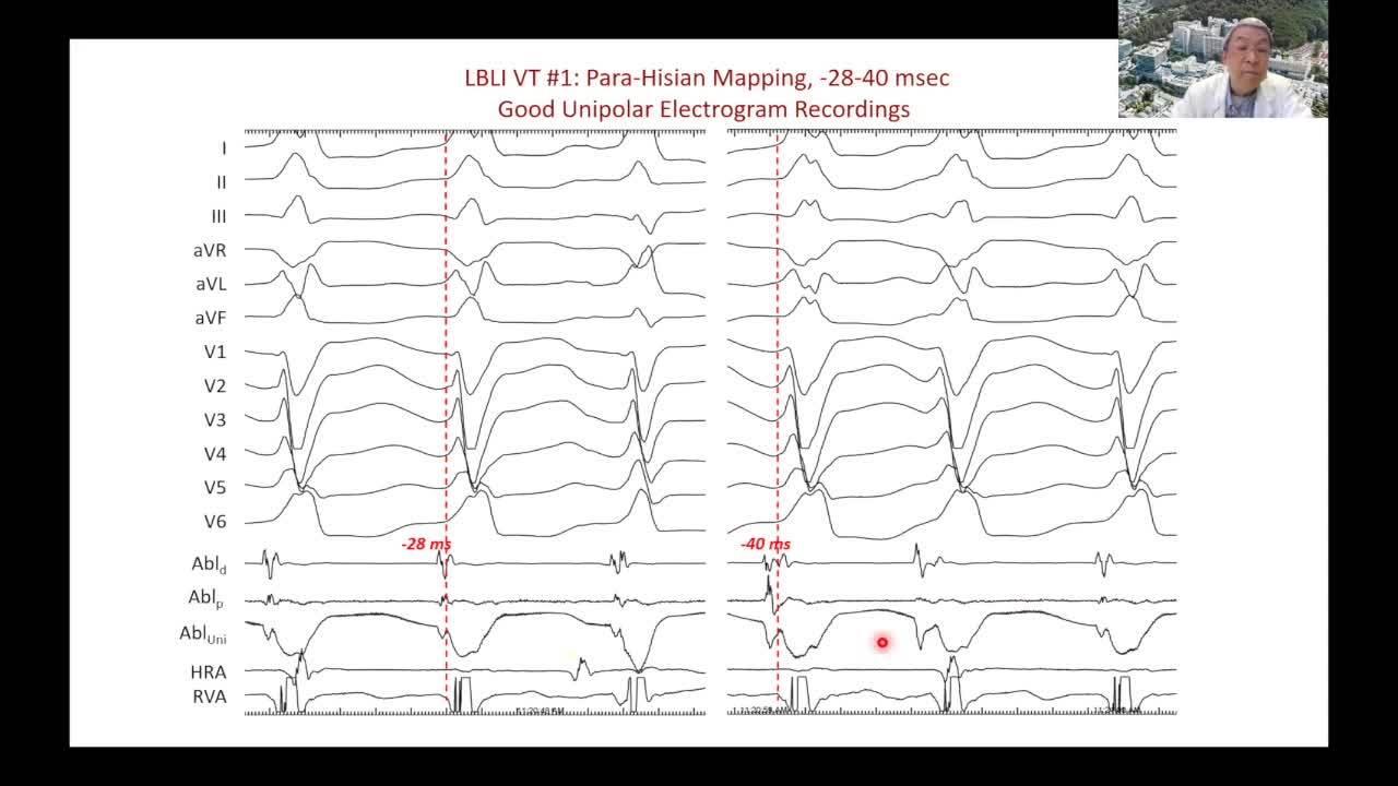 ECG Diagnosis and Catheter Ablation in Patients with Genetic Arrhythmia Syndromes with Henry Hsia, MD Header Image