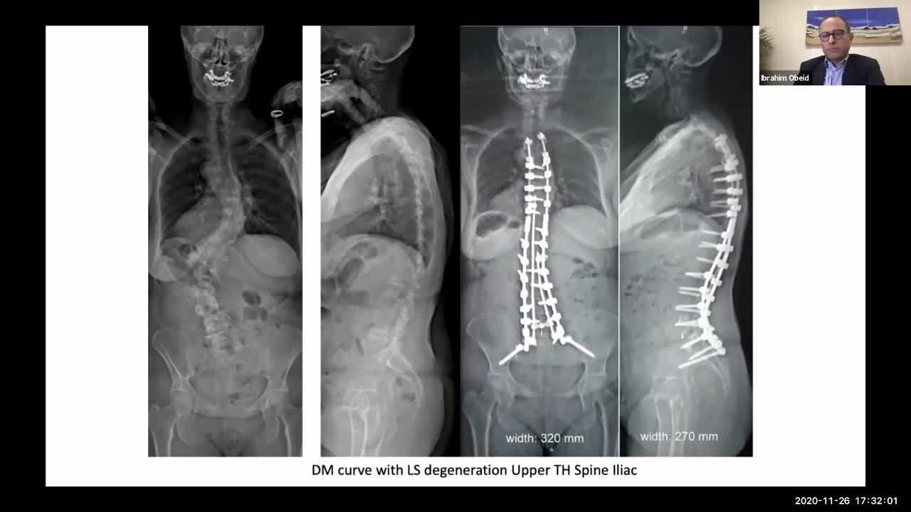 An image from the "Spine Time Webinar - Adult Degenerative Deformity & Predictive Analytics" video on the JnJInstitute.com website.