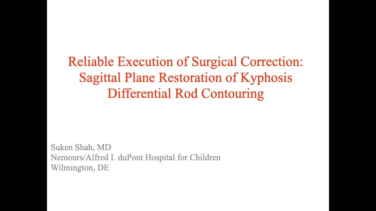 image from "Reliable Execution of Surgical Correction: Sagittal Plane Restoration of Kyphosis Differential Rod Contouring with Suken Shah, MD" video on jnjinstitute.com.