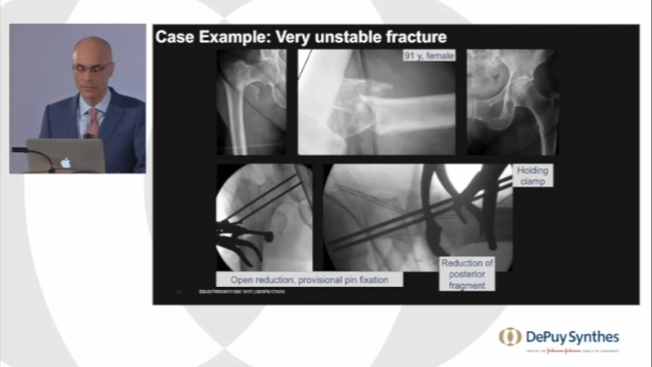 Managing Geriatric Hip Fractures: TFN-Advanced Augmentation System - Patient Indications using Case Examples with Michael Blauth, MD