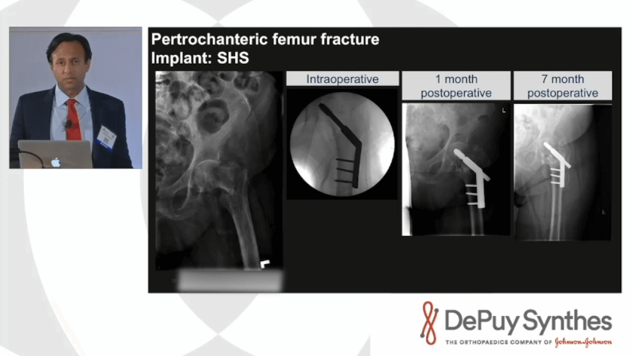 Managing Geriatric Hip Fractures: TFN™ADVANCED Augmentation System - Retrospective Case Reviews with Sunny Konda, MD thumbnail image