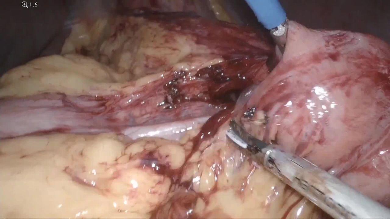 An Image from: "Complete Redo of the Gastro-Jejunal Anastomosis for failed Gastric Bypass"