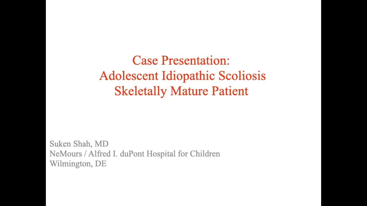 image from "Case Presentation: Adolescent Idiopathic Scoliosis Skeletally Mature Patient with Suken Shah, MD" video on jnjinstitute.com website