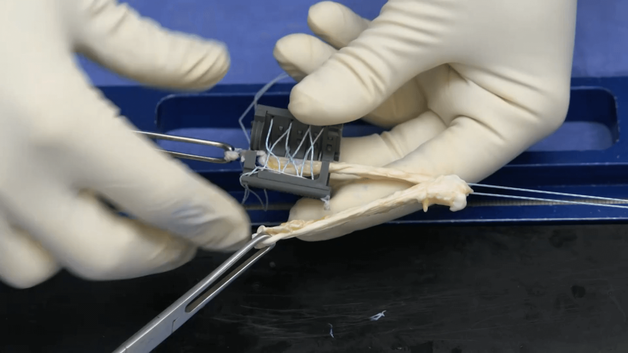 Quadriceps Tendon ACL Reconstruction with Scott Kaar, MD thumbnail image