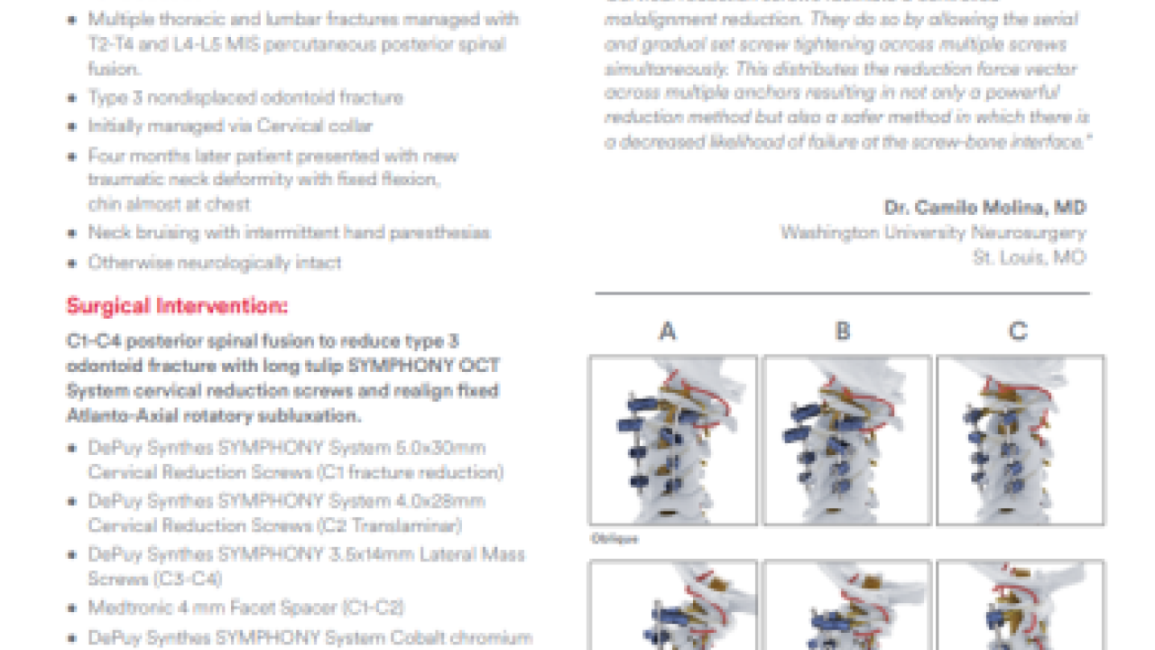 An image from the "Case Study - SYMPHONYTM OCT System: Cervical Traumatic Atlantoaxial Rotatory Subluxation Correction" PDF on the JnJInstitute.com website.