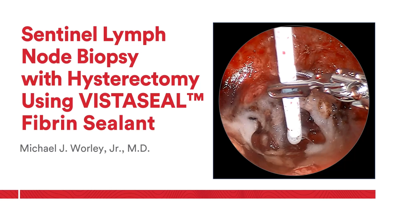 An Image From "Sentinel Lymph Node Biopsy and Hysterectomy using VISTASEAL Fibrin Sealant with Michael Worley, Jr., MD"