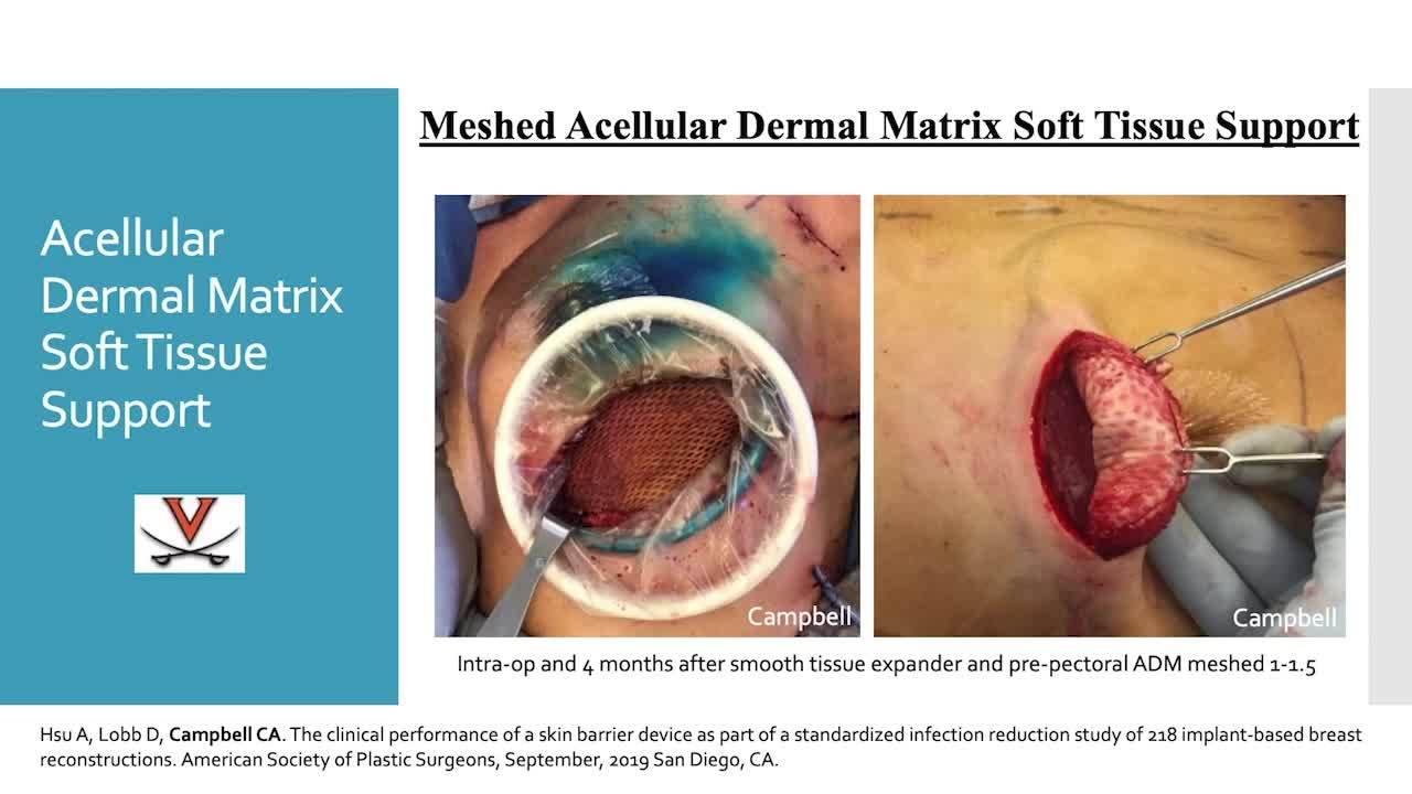 Optimizing Safety and Aesthetic Outcomes for Implant Based Reconstruction First Stage Surgical Planning with Chris Campbell, MD Header Image