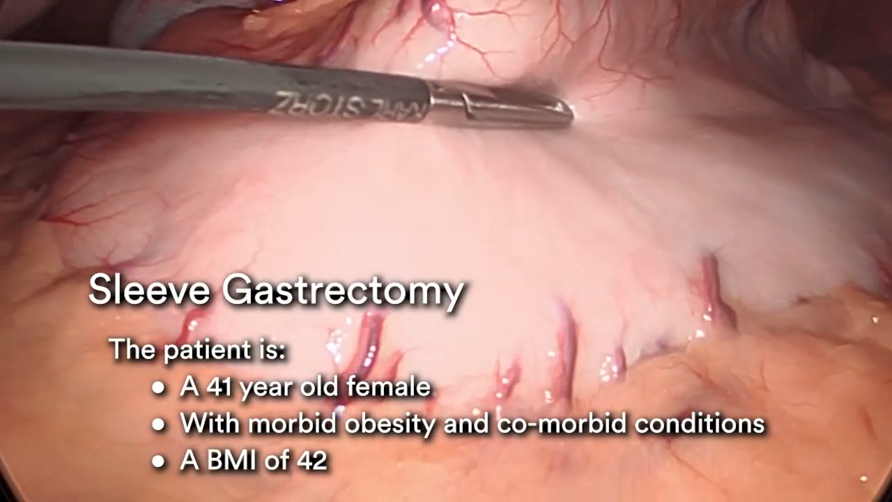Sleeve Gastrectomy Using HARMONIC 1100 Shears and the ECHELON 3000 with Brandon Helbling, MD