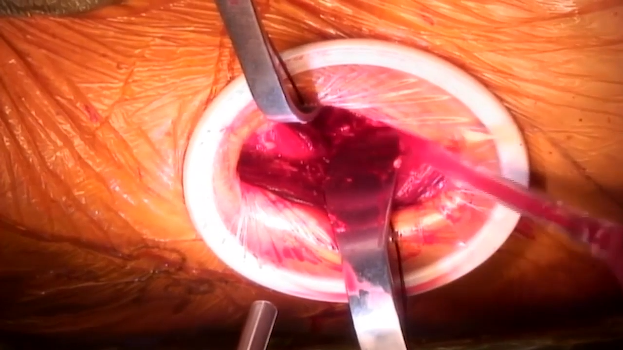 image of Anterior Approach: Neck Cut with Joel Matta, MD video on jnjinstitute.com