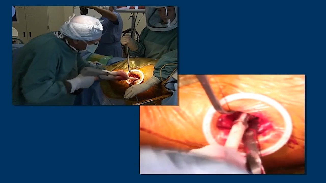 image of Anterior Approach: Acetabular Reaming & Cup Insertion with Joel Matta, MD video on jnjinstitute.com