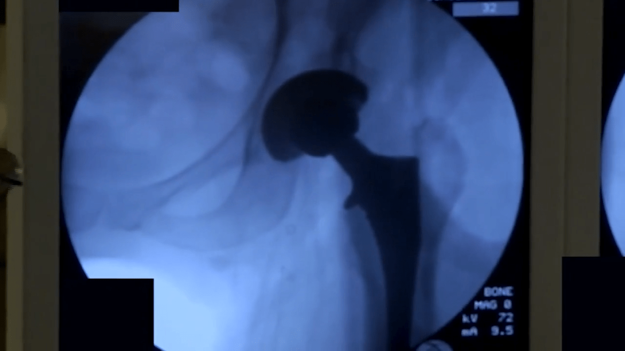 image of Anterior Approach: Final Implantation with Joel Matta, MD video on jnjinstitute.com