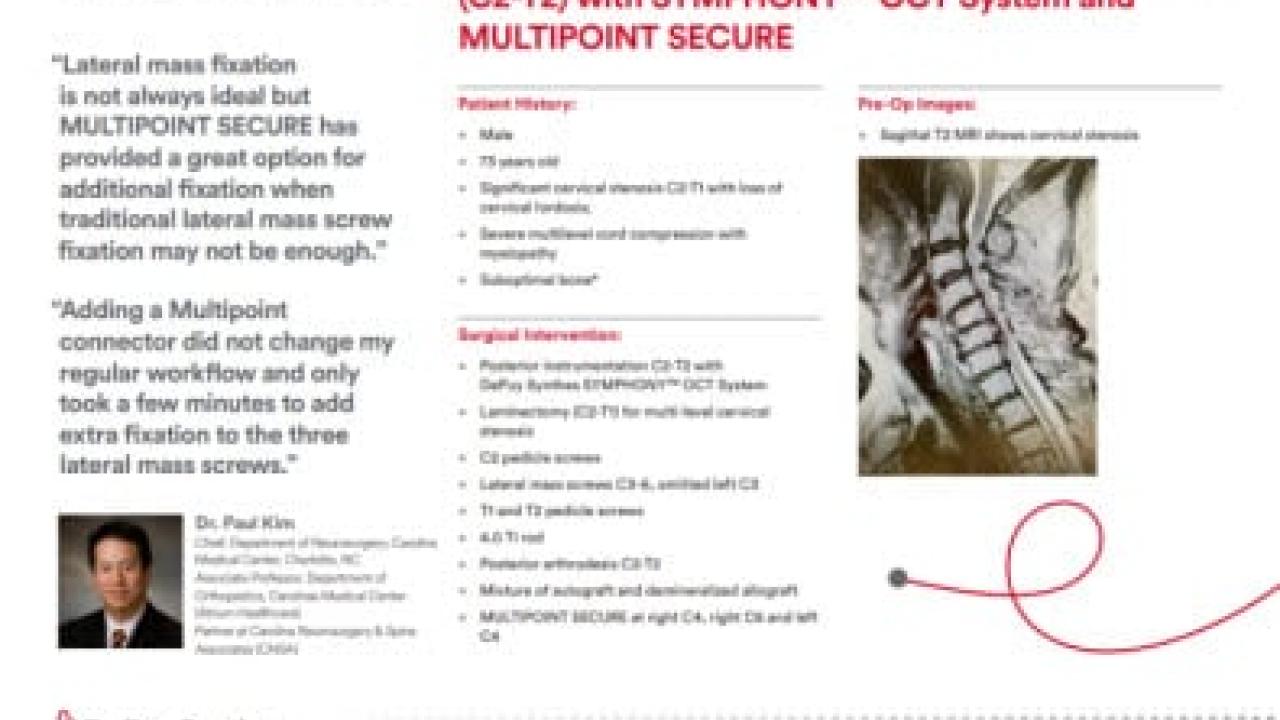 An image from the "Posterior Cervicothoracic Laminectomy & Fusion (C2-T2) with SYMPHONY™ OCT System & MULTIPOINT SECURE with Paul Kim, MD" PDF on the JnJInstitute.com website.