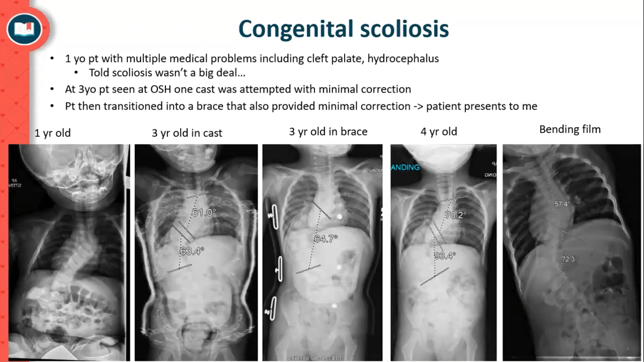An image from the "EOS: Congenital Scoliosis & Chest Wall Malformations with Michelle Welborn, MD" video on the JnJInstitute.com website.