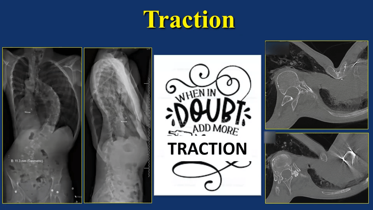 An image from the "EOS: Staying Out of Traction Trouble with Firoz Miyanji, MD" video on the JnJInstitute.com website.