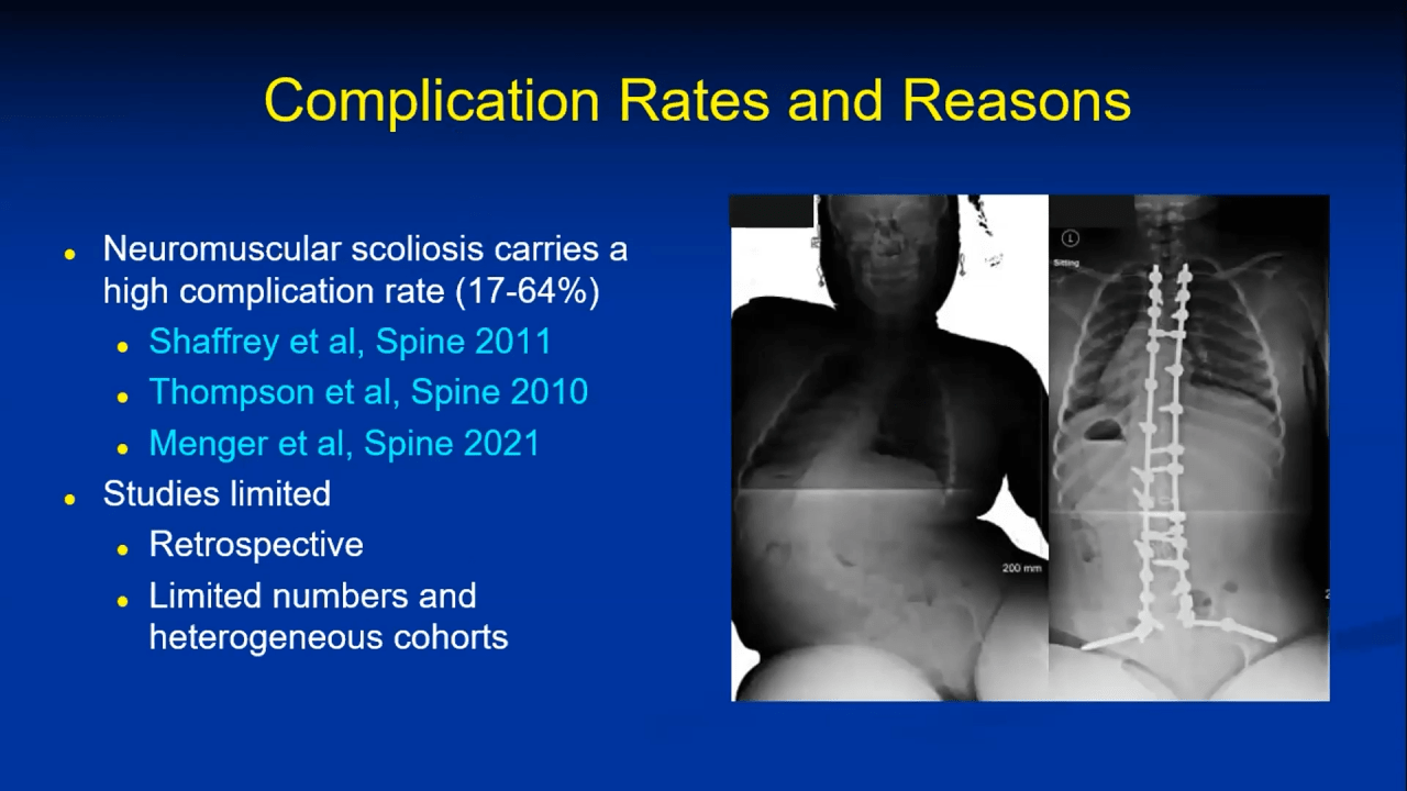 An image from the "Avoiding Complications in Neuromuscular Scoliosis with Amer Samdani, MD" video on the JnJInstitute.com website.