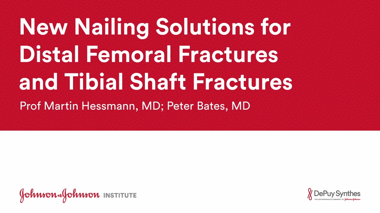 An image from the "New Nailing Solutions for Distal Femoral Fractures & Tibial Shaft Fractures with Prof Martin Hessmann, MD & Mr Peter Bates, MD" video on the JnJInstitute.com website.