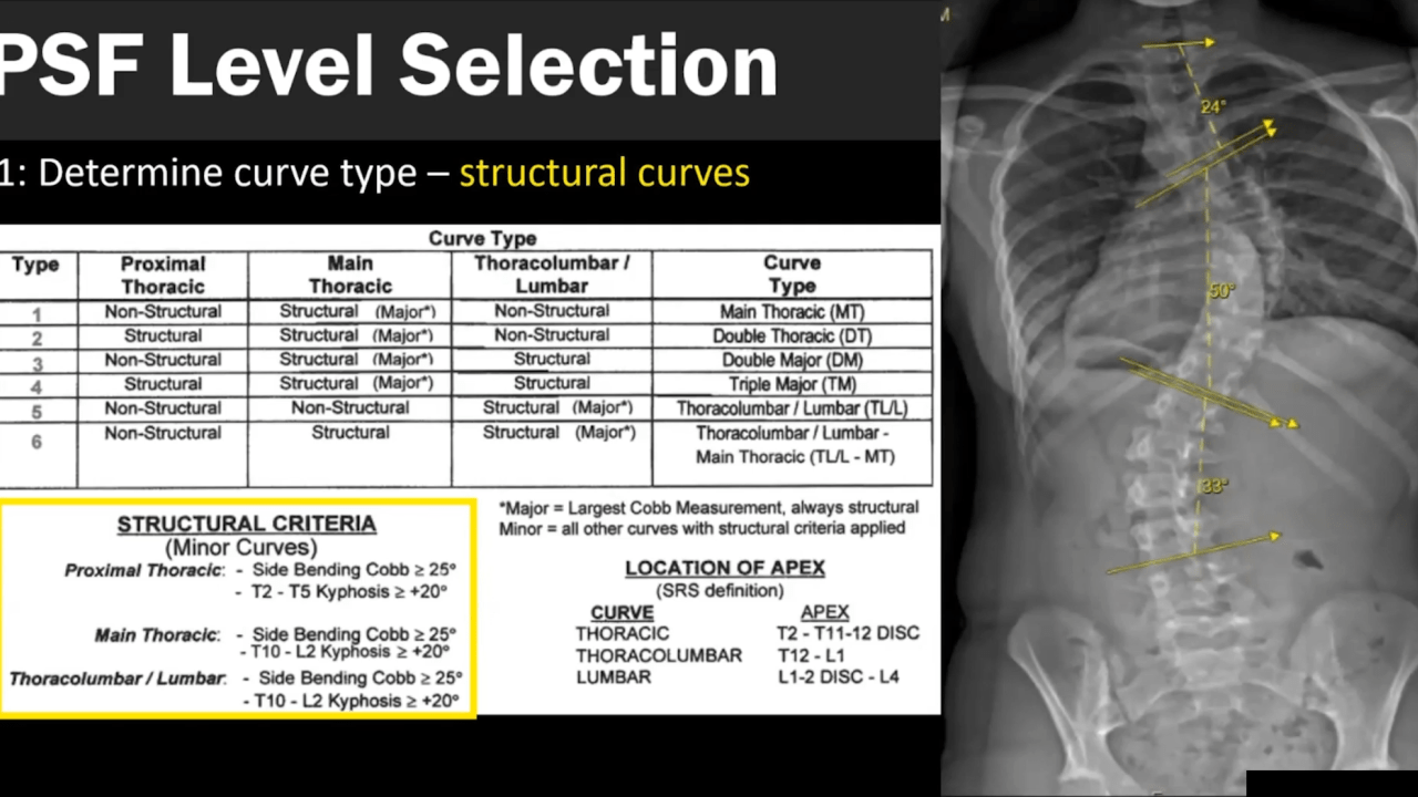 An image from the "Adolescent Idiopathic Scoliosis: Surgical Level Selection with Jennifer Bauer, MD" video on the JnJInstitute.com website.
