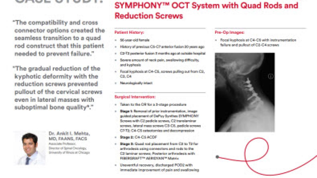 An image from the "Complex Revision of Proximal Fusion Failure Using SYMPHONY™ OCT System with Quad Rods & Reduction Screws with Ankit Mehta, MD" PDF on the JnJInstitute.com website.