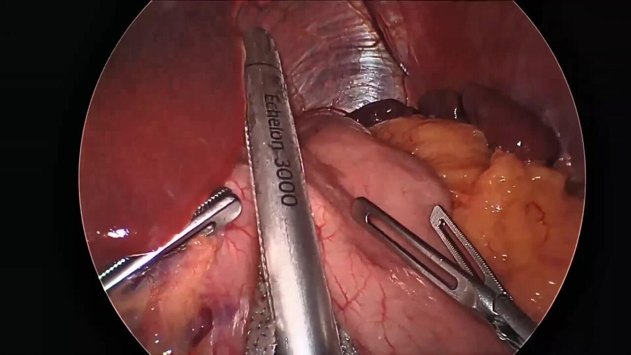 An image from "Sleeve Gastrectomy with the ECHELON 3000 stapler and ECHELON Staple Line Reinforcement"