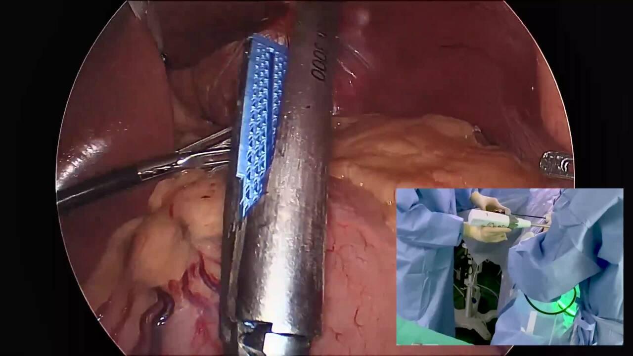 An image from "Gastric Bypass with the ECHELON 3000 stapler"