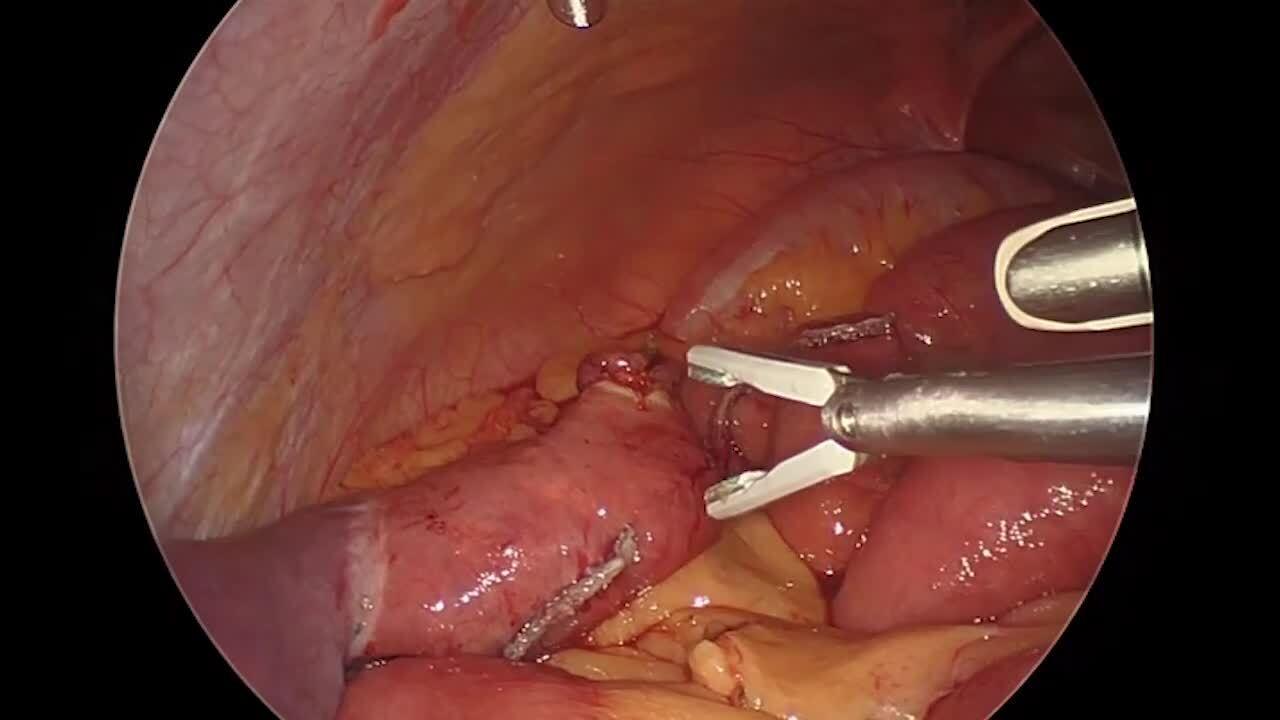 An image from "Gastric Bypass Revision with the ECHELON 3000 stapler"