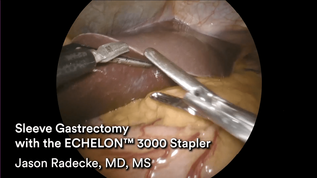 An Image From "Sleeve Gastrectomy with the ECHELON 3000 stapler, ECHELON Staple Line Reinforcement, and ENSEAL X1 Curved Jaw Tissue Sealer"