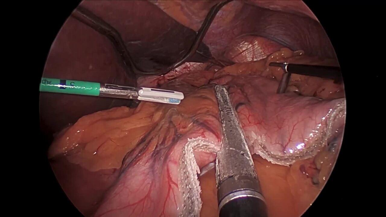 An image from "ECHELON 3000 stapler in Bariatric Procedures"