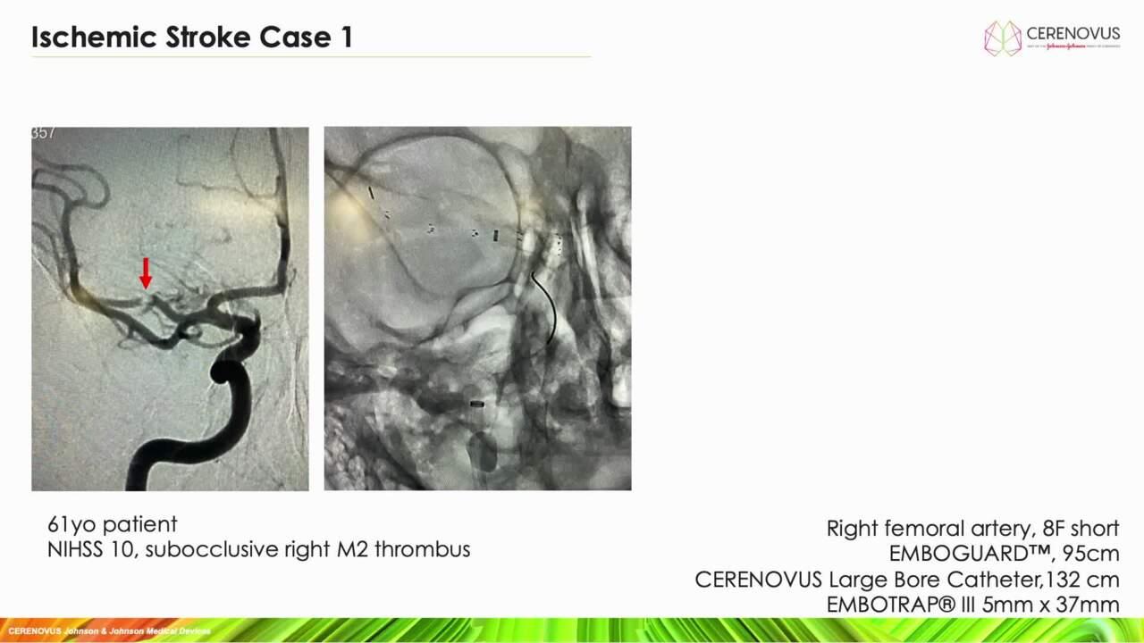 An Image from "EMBOGUARD™ Ischemic Stroke Case Reviews with Jan-Karl Burkhardt, MD"