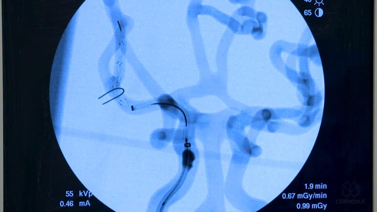 An Image from "CERENOVUS Stroke Solutions™ Review with Jan-Karl Burkhardt, MD"