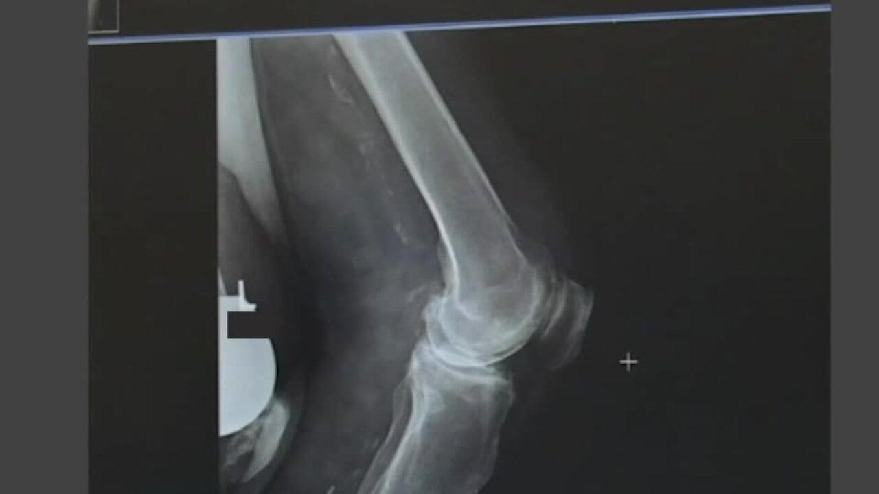 An image from the "ATTUNE Knee System & INTUITION Instruments:Patient Review: Imaging & Rationale with David Dalury, MD & David Fisher, MD" video on the JnJInstitute.com website.