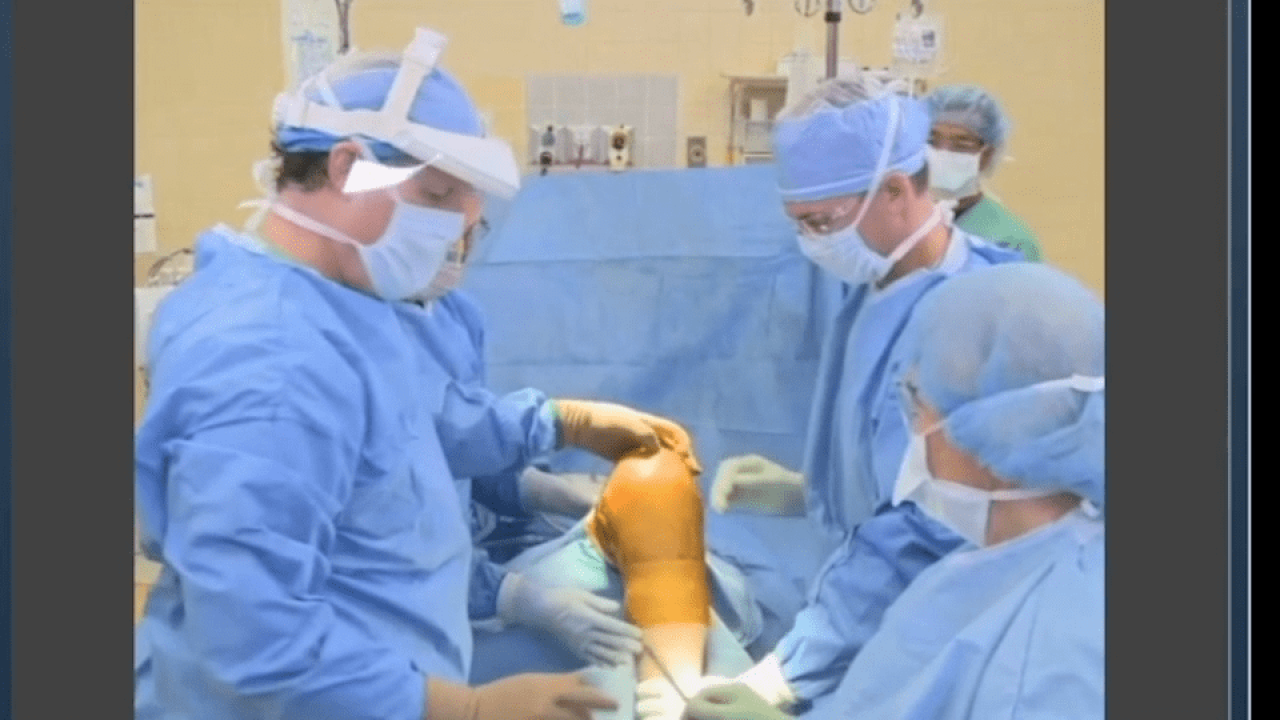 An image from the "ATTUNE Knee System & INTUITION Instruments: Total Knee Arthroplasty Exposure with David Dalury, MD & David Fisher, MD" video on the JnJInstitute.com website.