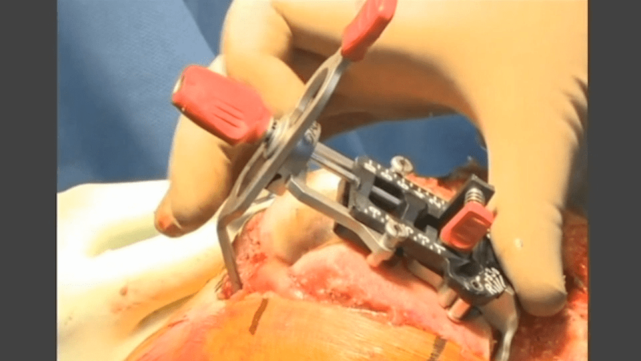 An image from the "ATTUNE Knee System & INTUITION Instruments: Total Knee Arthroplasty Distal Femoral Resection Measured Sizer with David Dalury, MD & David Fisher, MD" video on the JnJInstitute.com website.