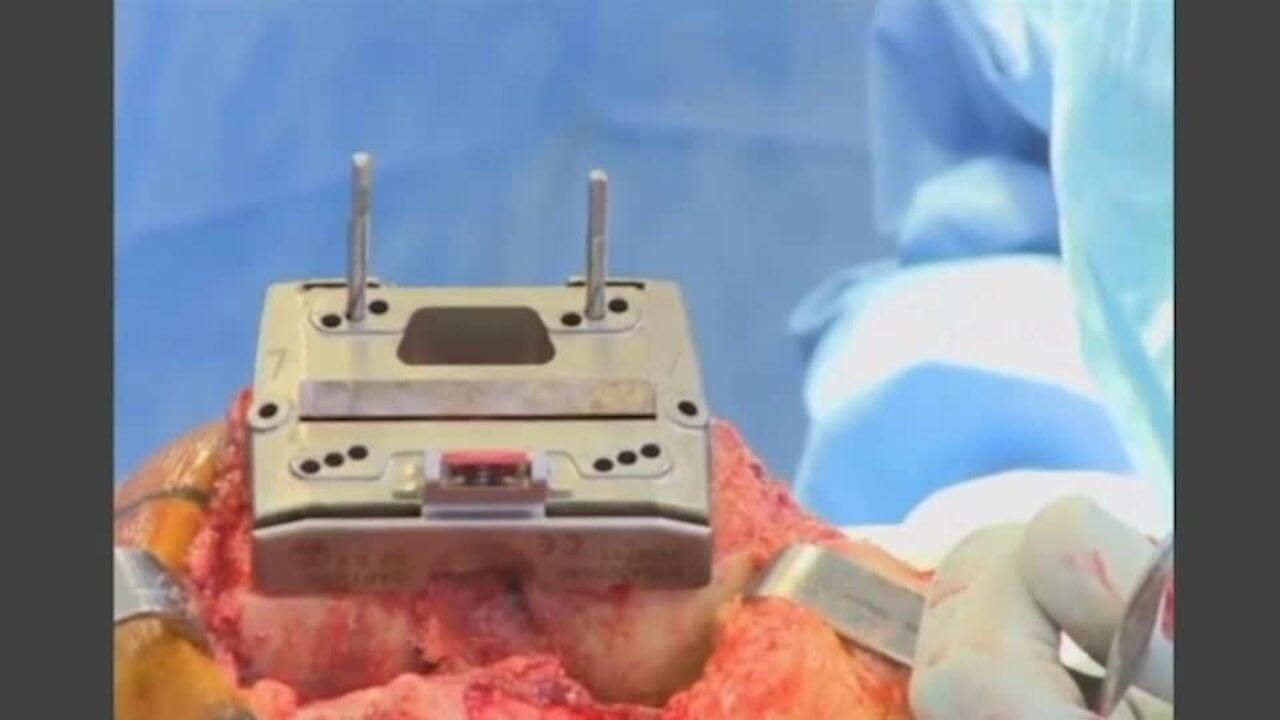 An image from the "ATTUNE Knee System & INTUITION Instruments: Total Knee Arthroplasty Femoral Finishing with David Dalury, MD & David Fisher, MD" video on the JnJInstitute.com website.