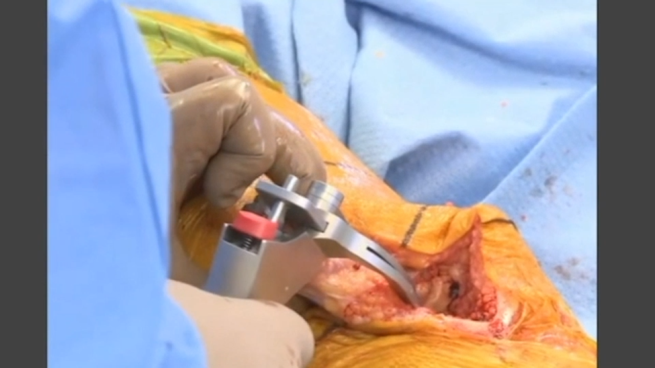 An image from the "ATTUNE™ Knee System & INTUITION™ Instruments Total Knee Arthroplasty: The Patella with David Dalury, MD & David Fisher, MD" video on the JnJInstitute.com website.