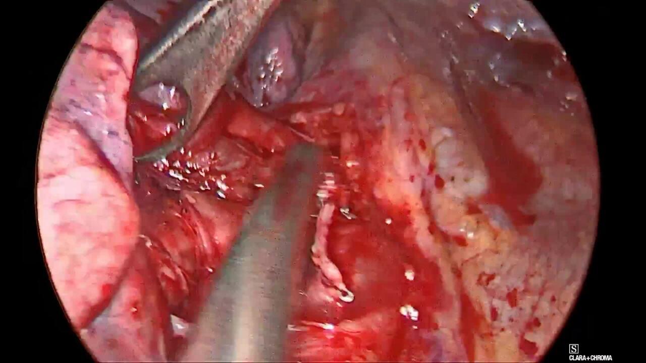 An Image From " VATS Wedge Resection and Lobectomy with ECHELON 3000 stapler, with John Roberts, MD"
