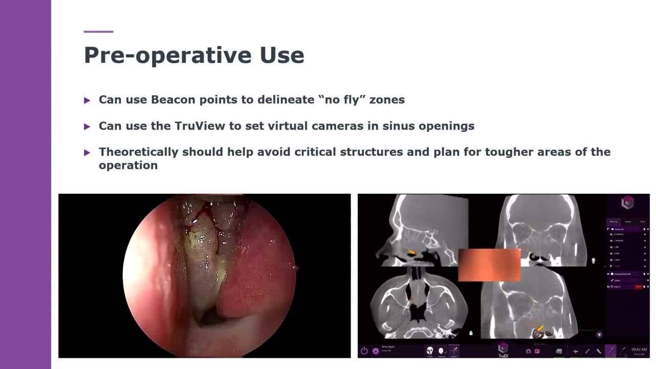 An Image From "TruDi in Complex Cases with Zachary Cappello, MD"