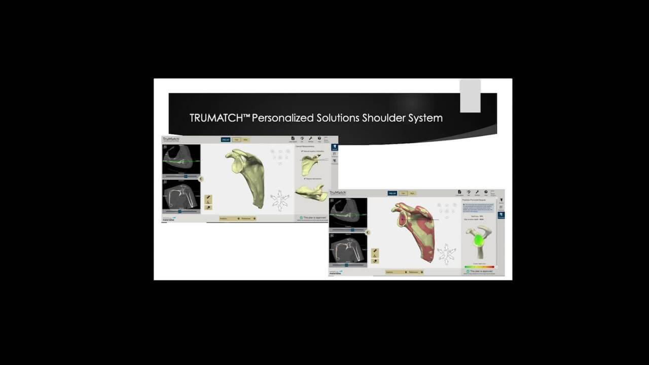 Thumbnail image of Anatomic & Reverse Shoulder Arthroplasty Case Review: TRUMATCH™ Personalized Solutions
