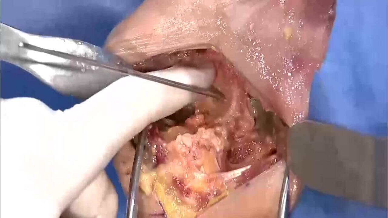 Thumbnail image of GLOBAL UNITE Reverse Shoulder Fracture: Glenoid Preparation with Carl Basamania, MD