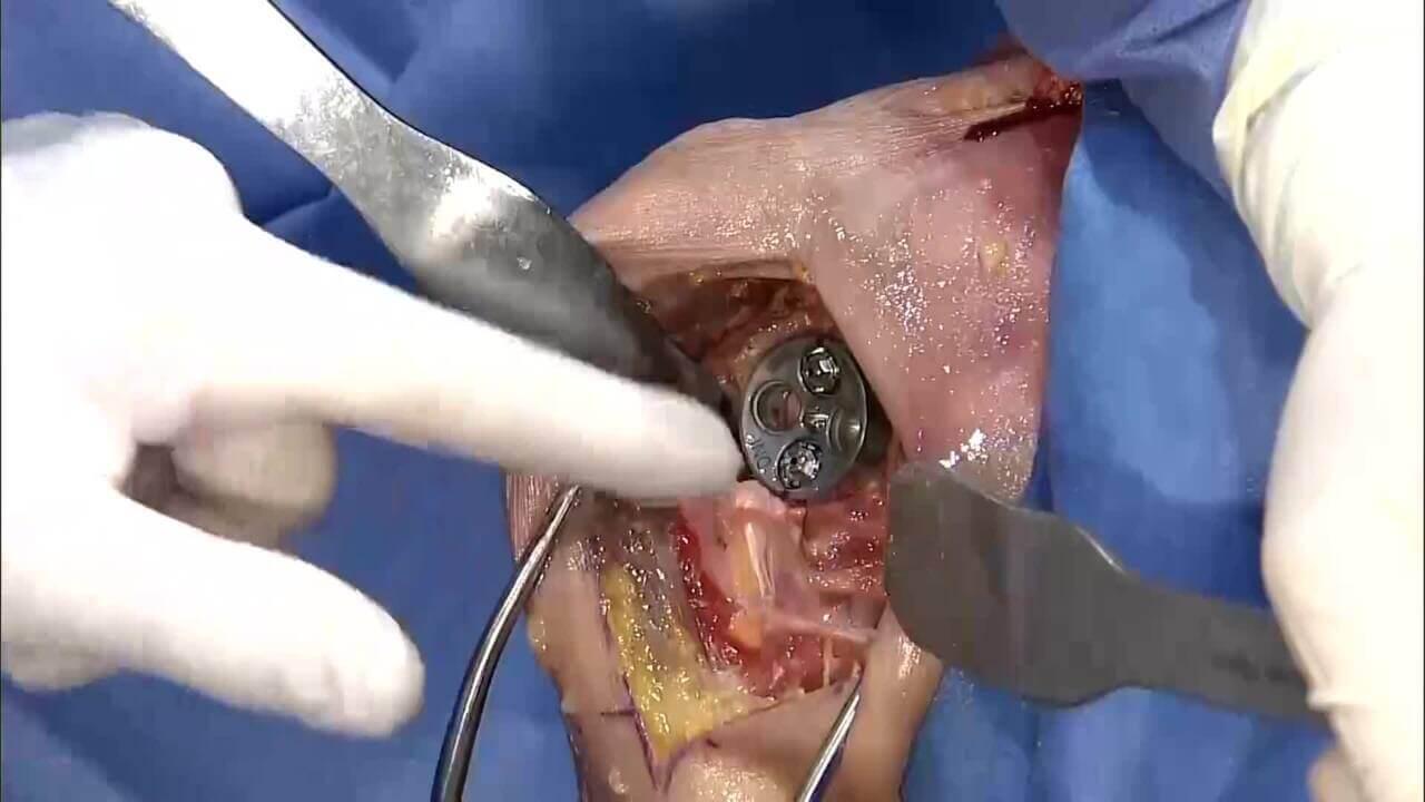 Thumbnail Image of GLOBAL UNITE Reverse Shoulder Fracture: Glenoid Implantation with Carl Basamania, MD