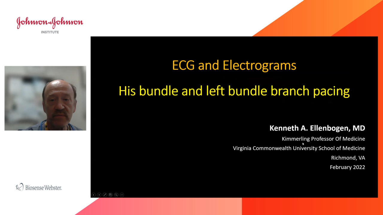 An Image From "Current Role of His bundle or LBBB area Pacing with Kenneth Ellenbogen, MD"