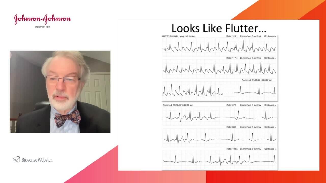 Ecg and intracardiac studies in patients with atrial flutter with john