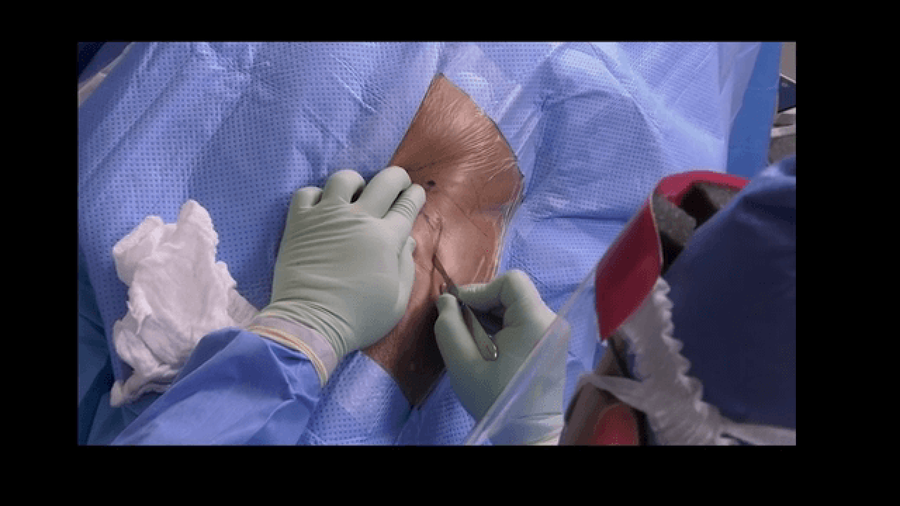Anterior Advantage™ Standard Table / Tableless THA Surgical Technique with Lee Rubin, MD thumbnail image