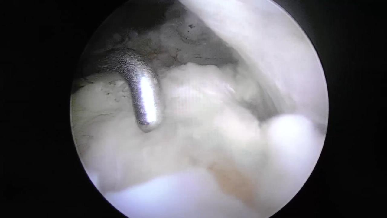 Posterolateral Corner Reconstruction using the Mitek Sports Medicine Knee Portolio with Dean Wang, MD thumbnail image