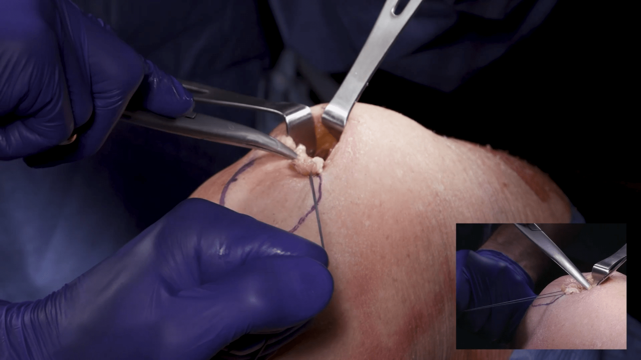 All-Inside ACLR using Quad Tendon: Graft Harvest with Justin Ernat, MD thumbnail image