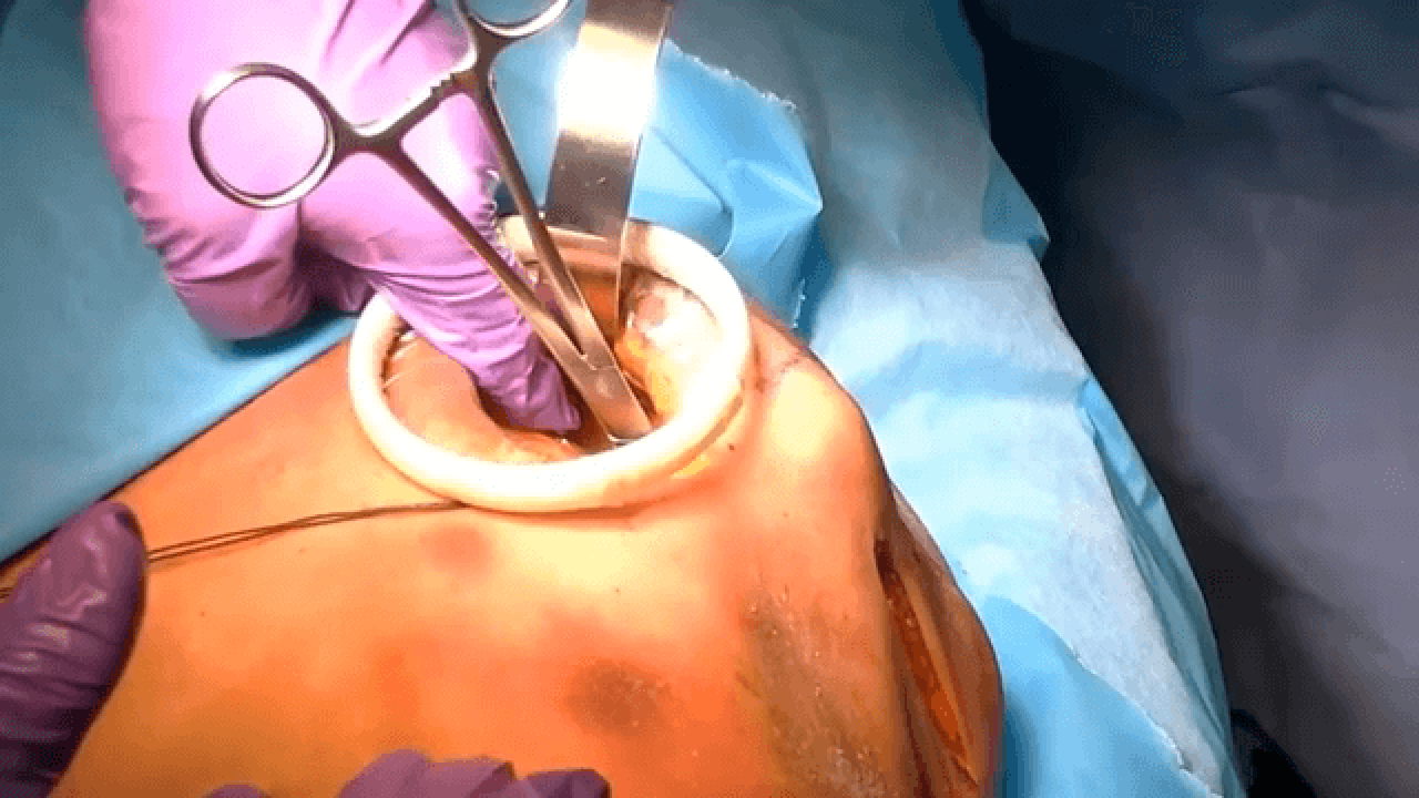 MatrixRIB™ System for Rib Fracture Fixation: Anterior Approach Presented by Nir Hus, MD thumbnail