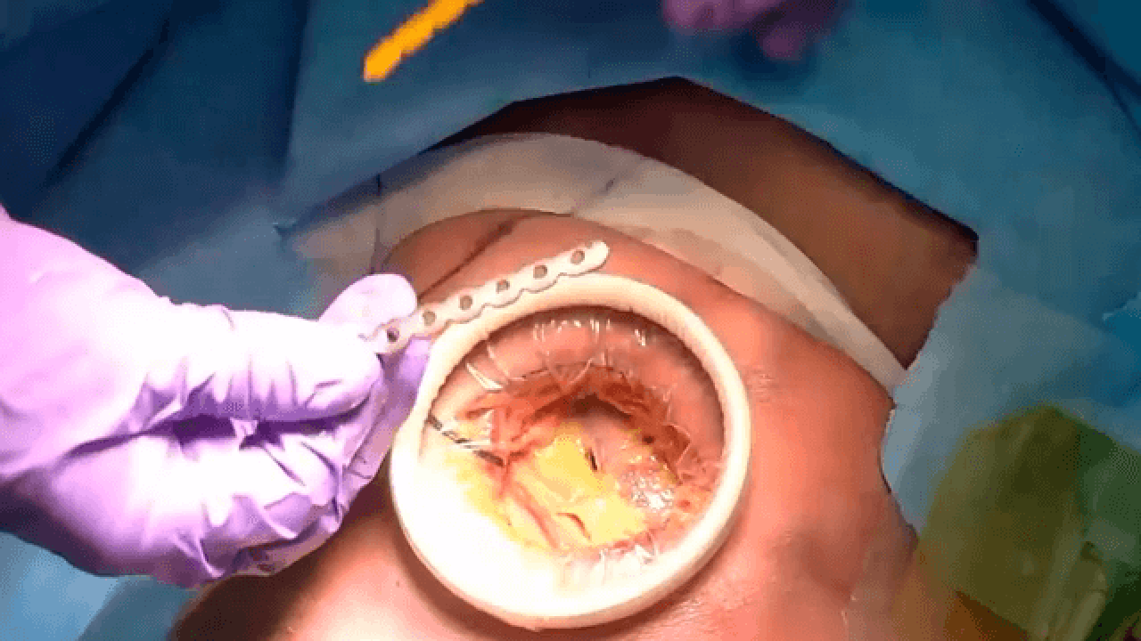 MatrixRIB™ System for Rib Fracture Fixation: Lateral Approach Presented by Nir Hus, MD thumbnail image