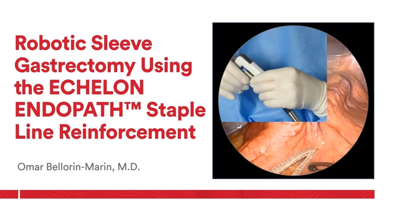 An Image From "Robotic Sleeve Gastrectomy Using the ECHELON ENDOPATH Staple Line Reinforcement with Omar Bellorin-Marin, MD"