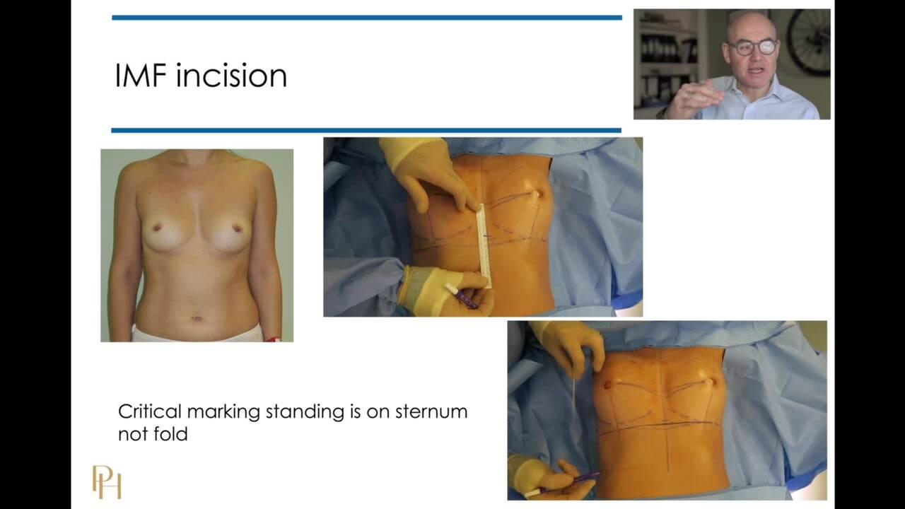 An Image From "How do you mark up for round breast implants?"