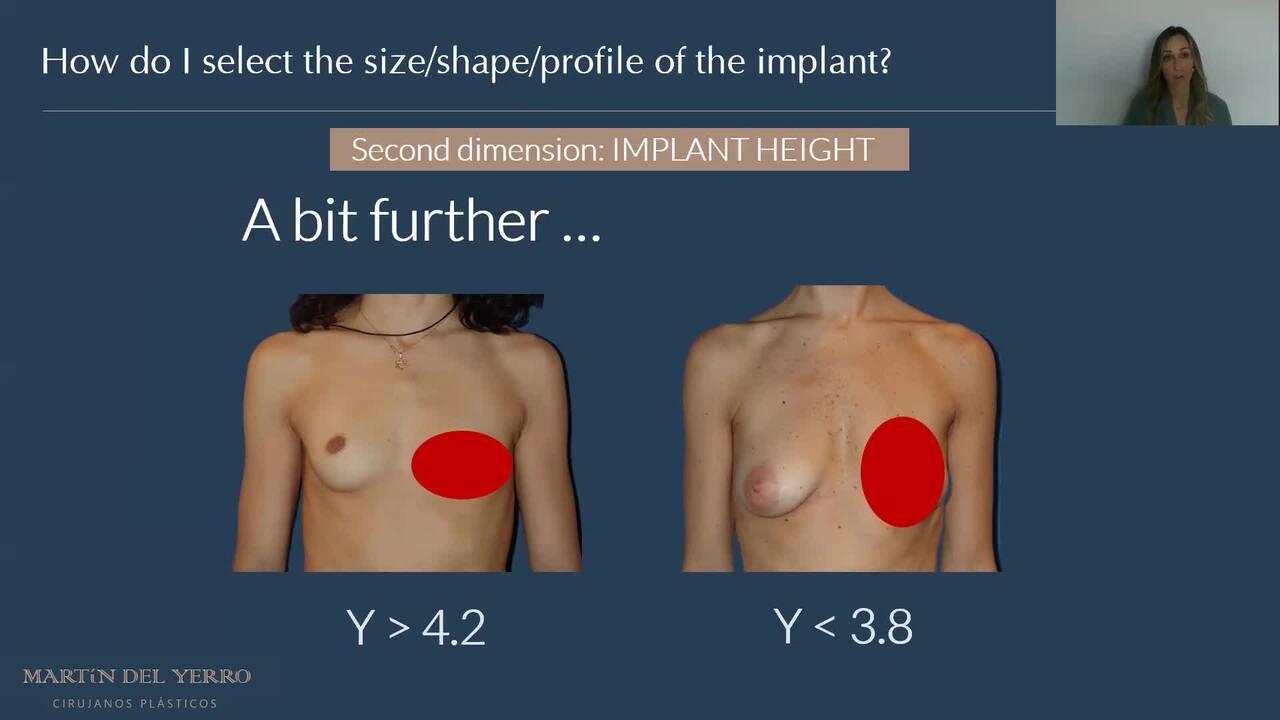 An Image From "How do you decide on the size, profile and shape of breast implants?"